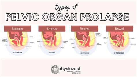 Prolaps – Wikipedia